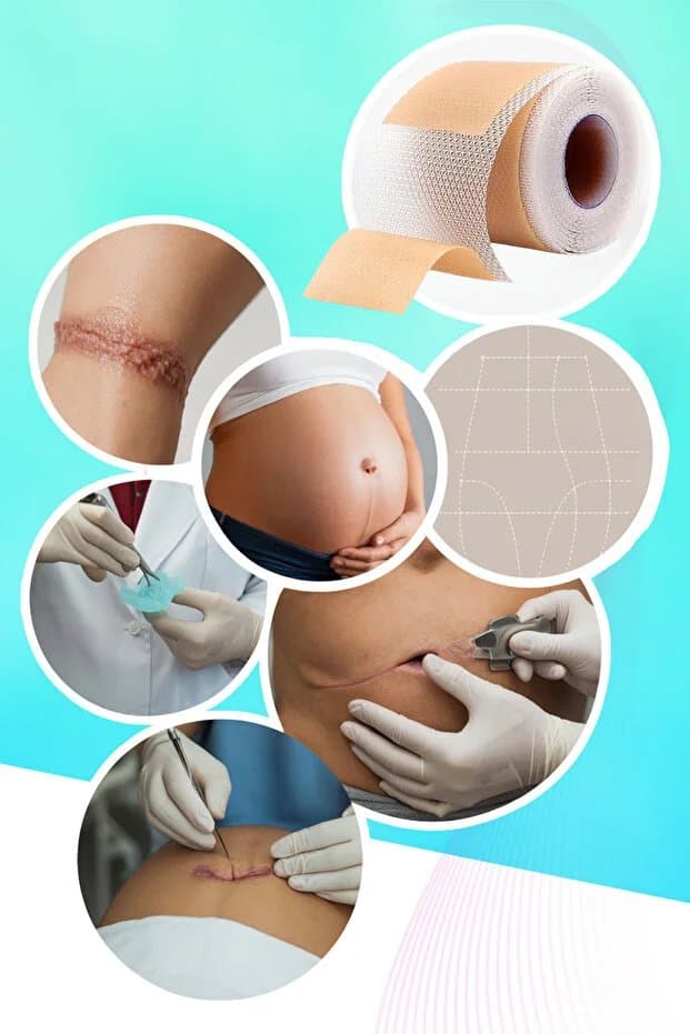 Premium Soft Silikon Yara İz Giderici Bandı %93 Etkili 2’li Set 6m - Keloid/Ameliyat/Sezaryen/Skar